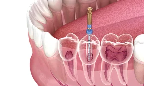 Root Canal
