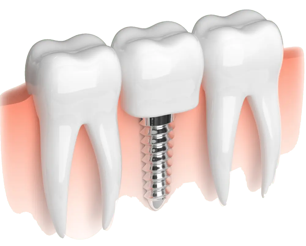 Teeth Filling