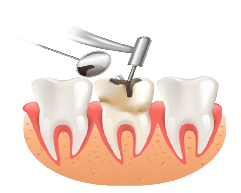 Teeth Filling